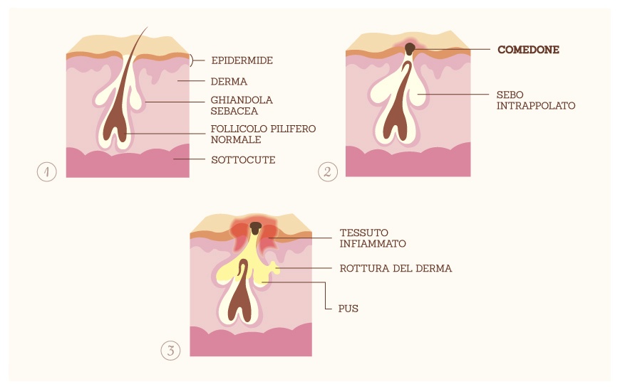 prenderci cura della pelle grassa comedone